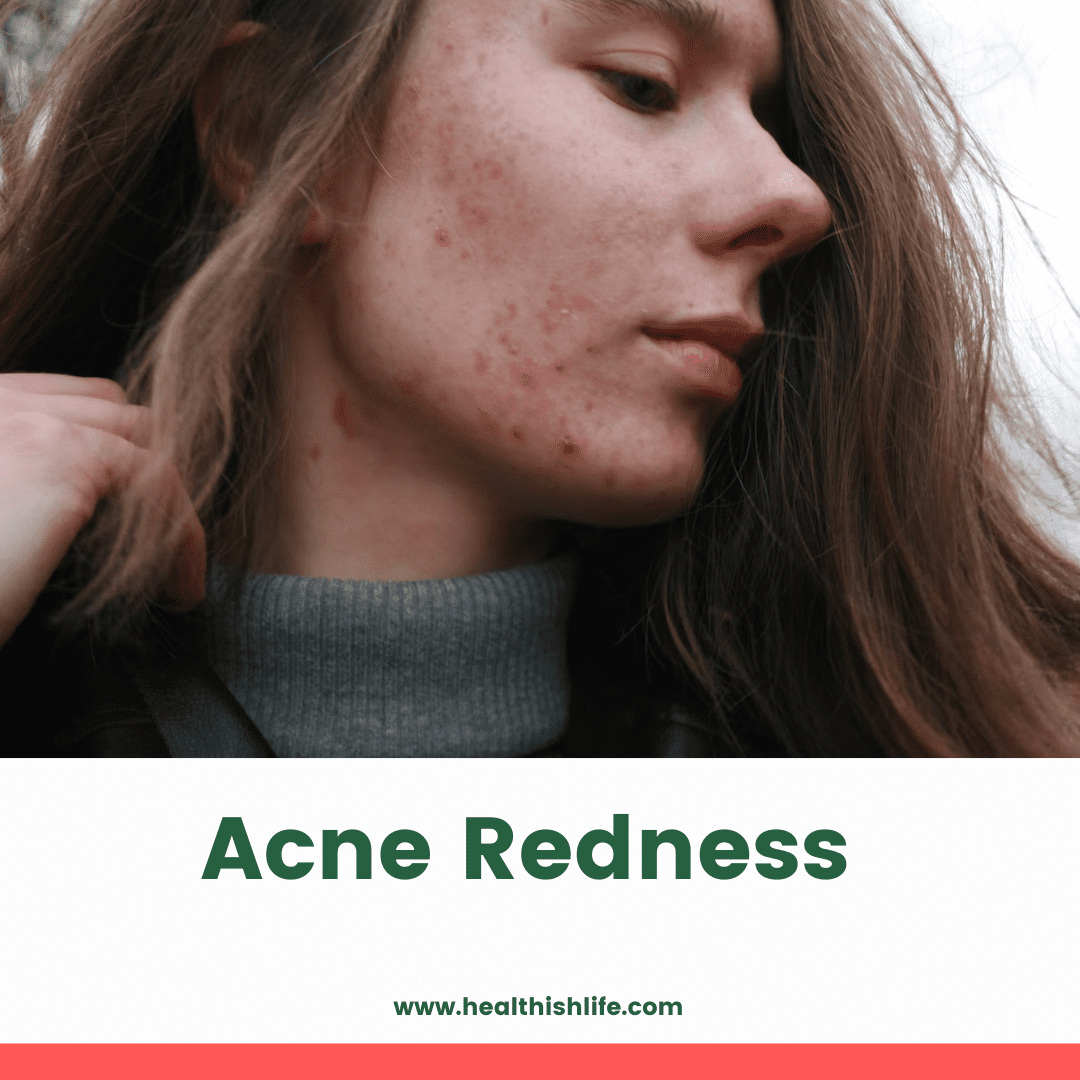 acne-redness-causes-treatment-prevention-healthishlife